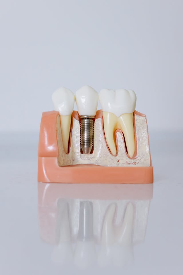 implante convencional en hueso Implante dental convencional integrado en hueso maxilar